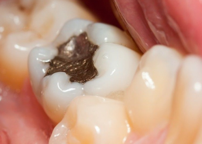 Cosmetic Dental Fillings 1