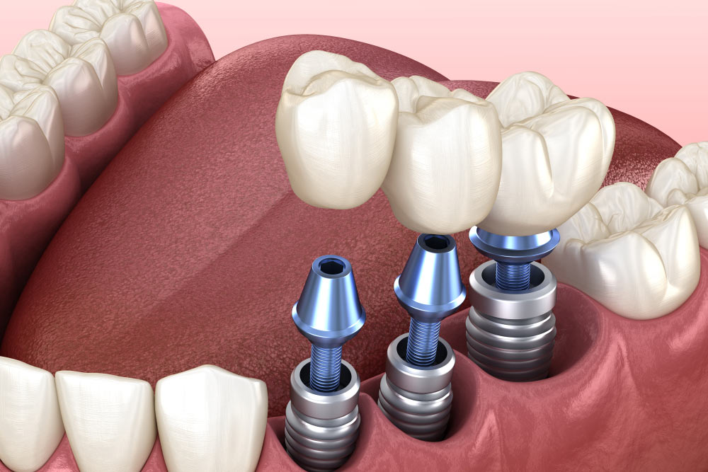 Dental Implants 1