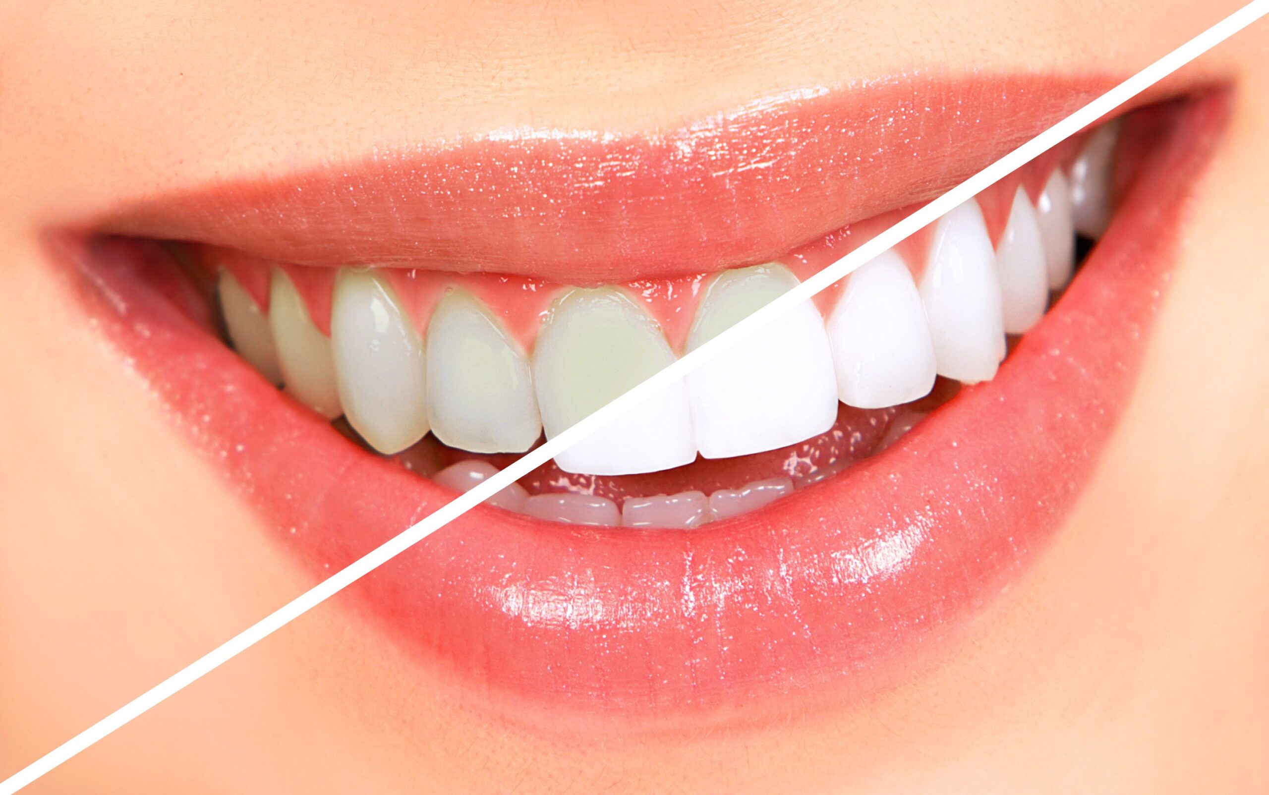 Teeth Whitening 1